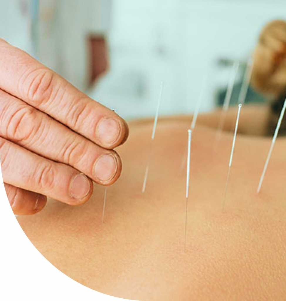 Dry needling