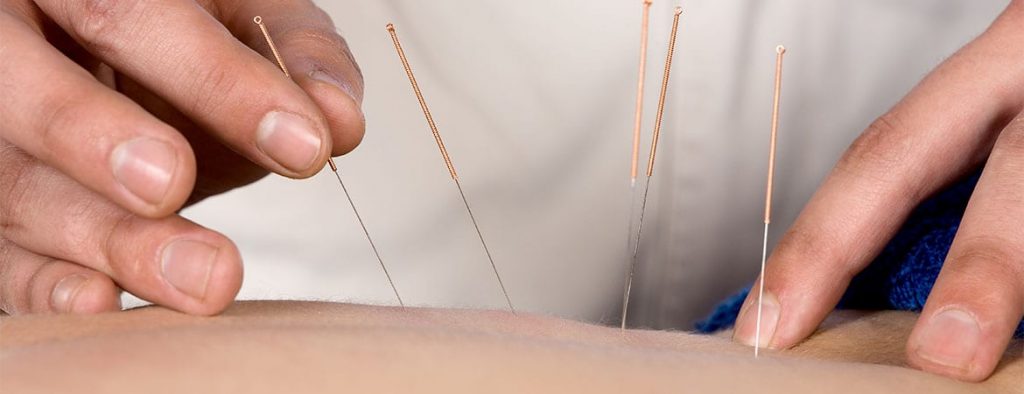 Needling