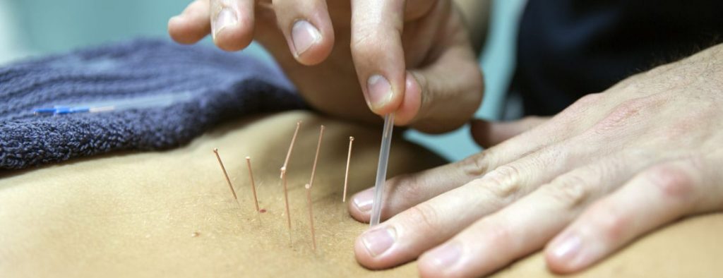Needling
