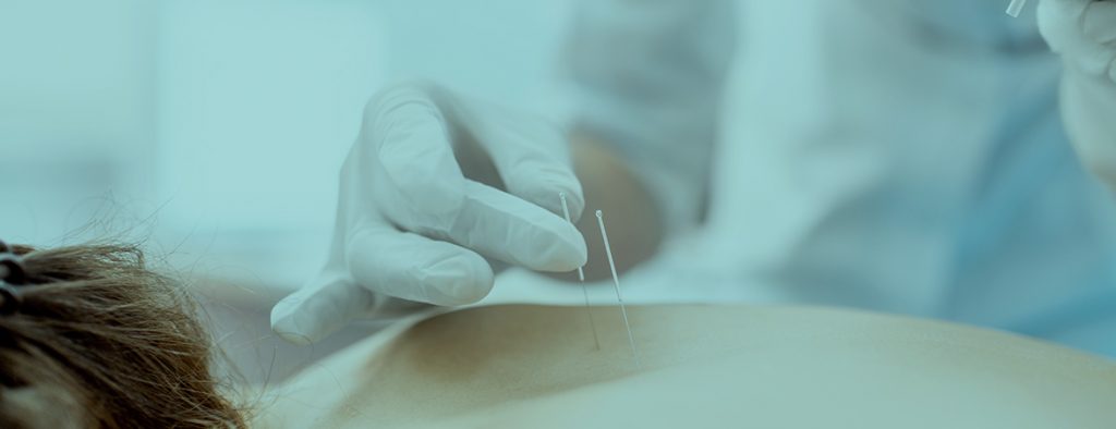 Dry Needling
